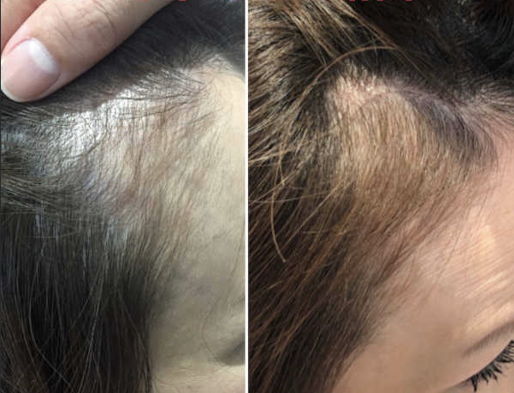 ビフォーアフター 生え際の変化（1.5ヶ月）