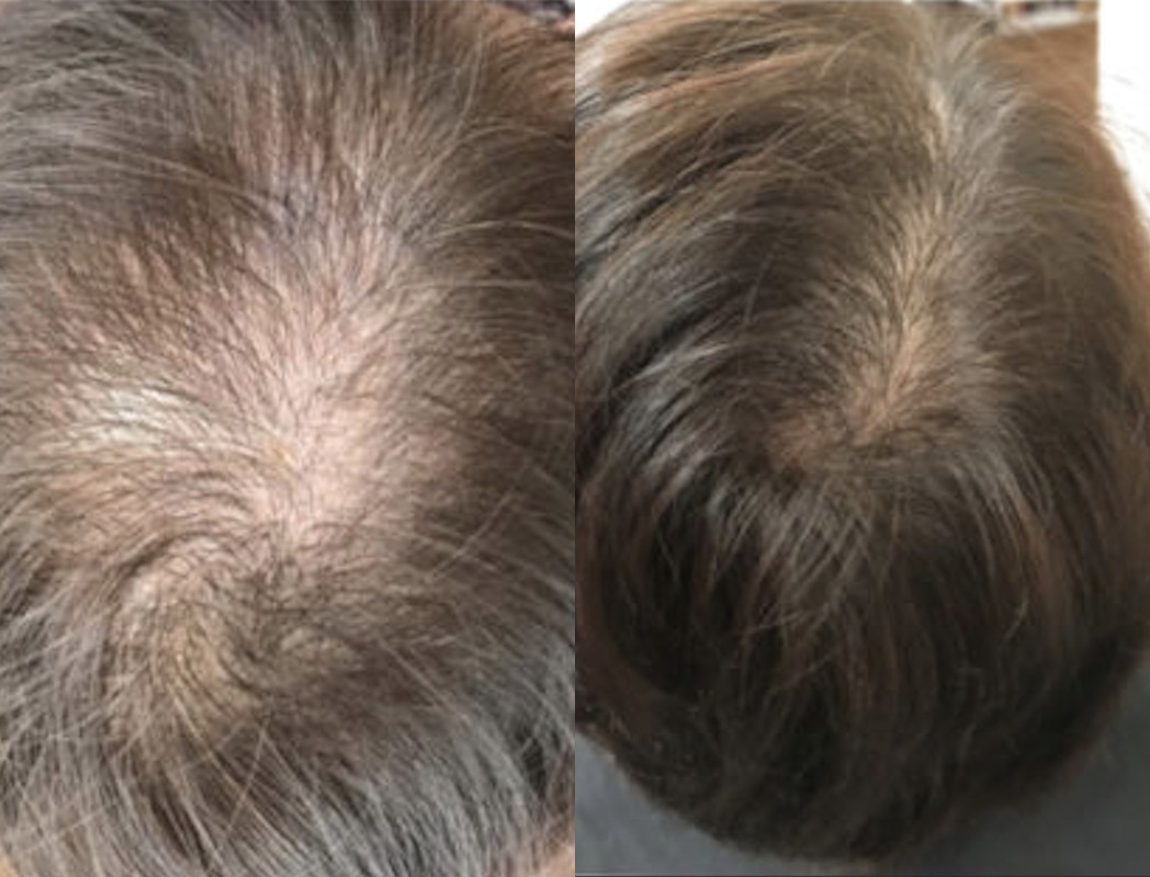 ビフォーアフター 頭頂部の変化