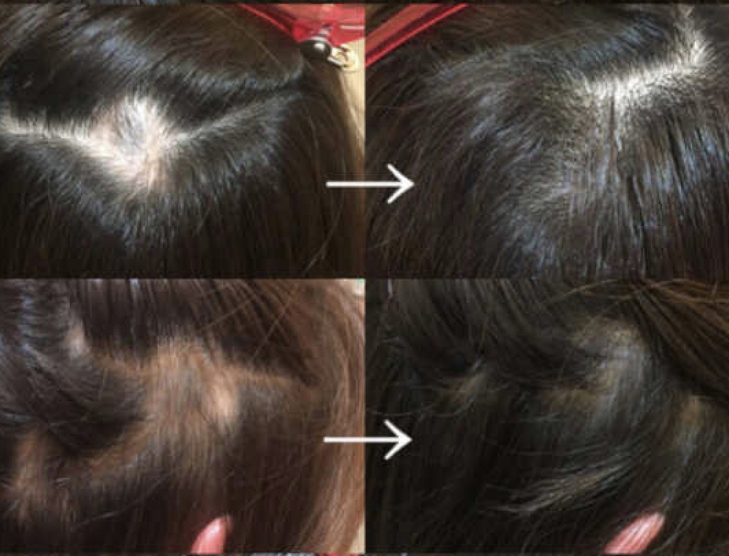 ビフォーアフター 生え際の変化（4ヶ月）
